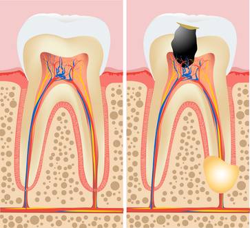 Endodoncias dentales Valencia Clínica Dental Almar