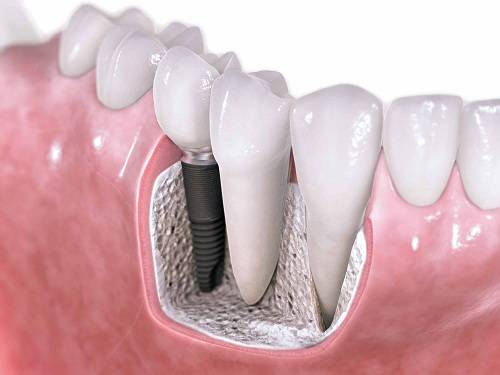 Implantes dentales Valencia Clínica Dental Almar