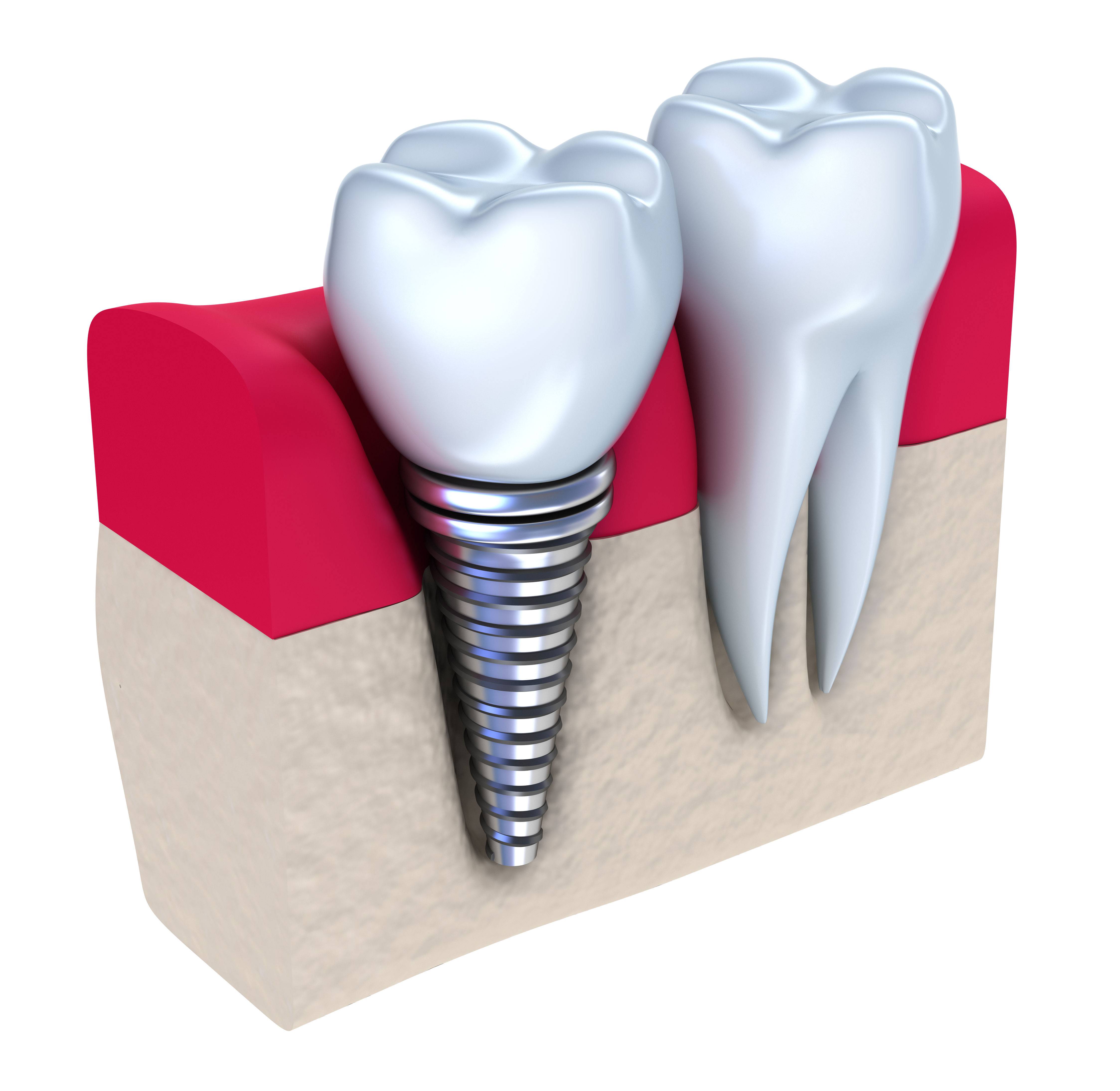 El Mejor Precio En Implantes Dentales Valencia Cl Nica Dental Almar