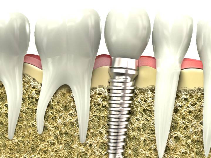 Implantes Dentales Valencia Cl Nica Dental Almar