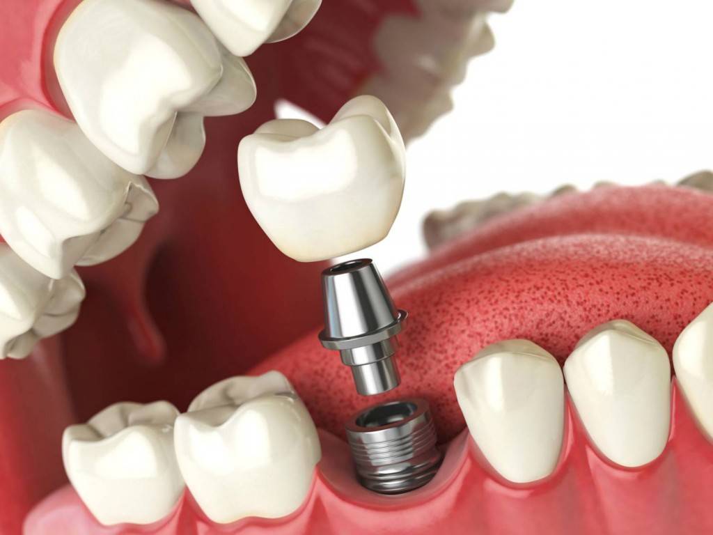 Presupuesto Implantes Dentales Valencia Cl Nica Dental Almar