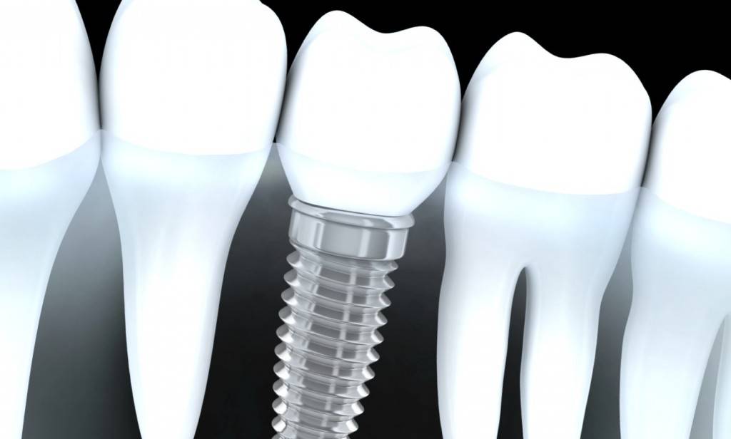 Implantes Valencia – Clínica Dental Almar